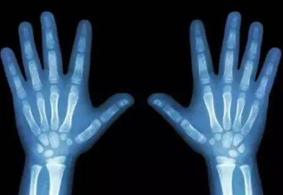 兒童生長發育測試儀廠家與您一起正確認識孩子骨齡